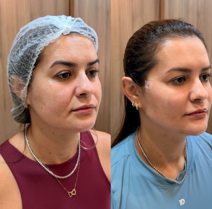 Harmonização Facial
